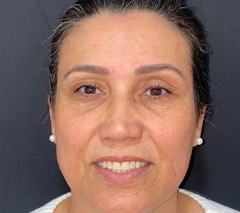 Rosto depois da aplicação de toxina botulínica