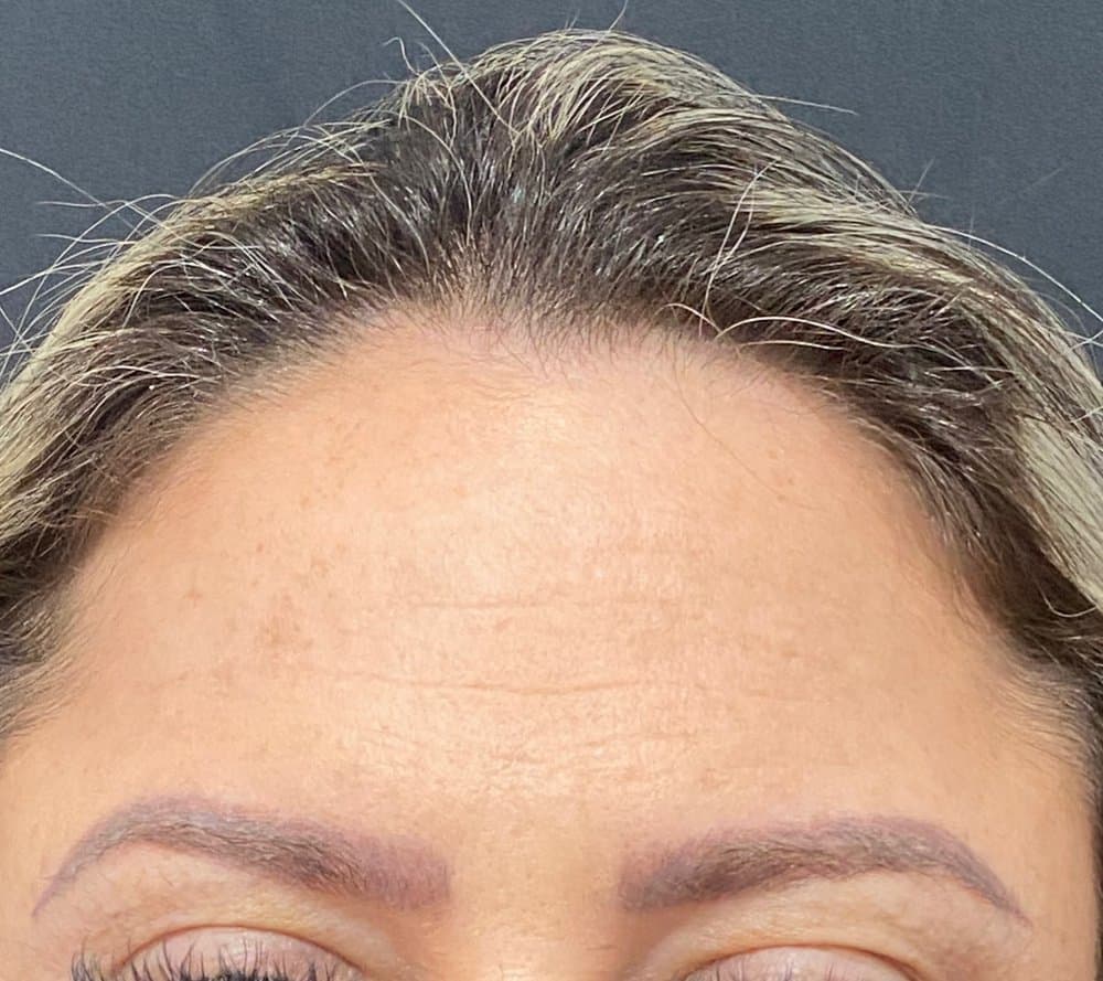 Testa lisa depois da aplicação de toxina botulínica