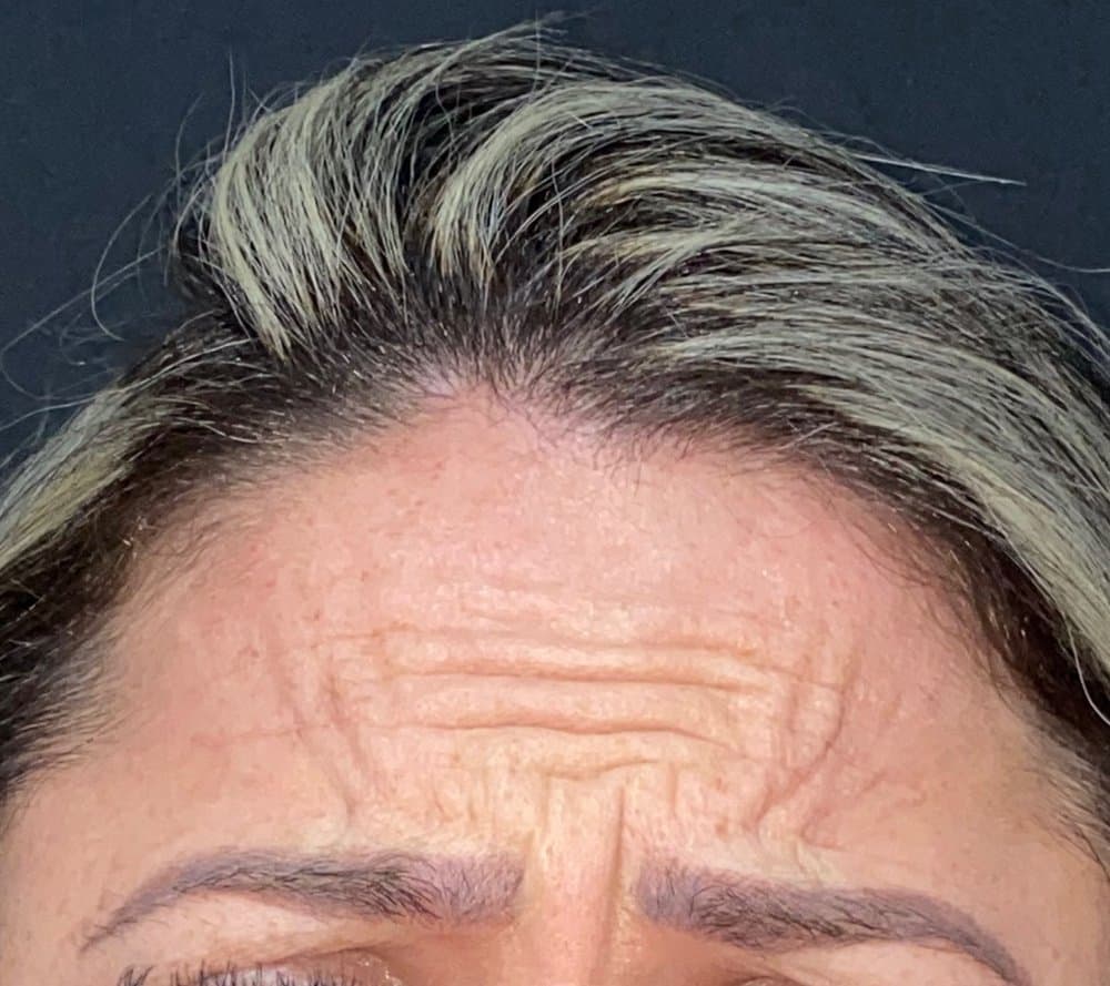 Testa com linhas de expressão antes da aplicação de toxina botulínica